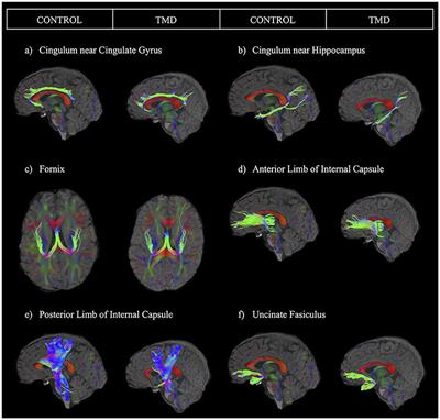 White Matter Diffusion Properties in Chronic Temporomandibular Disorders: An Exploratory Analysis